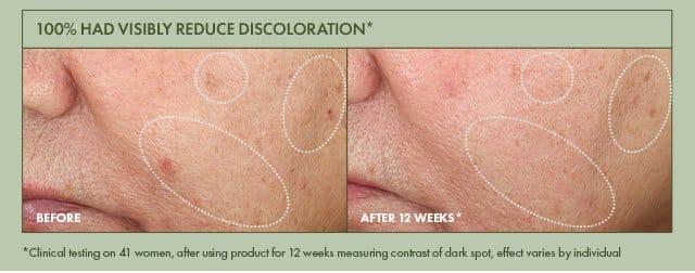100% had visibly reduce Discoloration* | Before | AFTER 12 WEEKS* | *Clinical testing on 41 women, after using product for 12 weeks measuring contrast of dark spot, effect varies by individual
