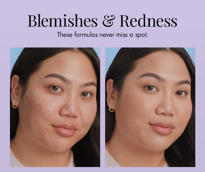 Blemishes & Redness