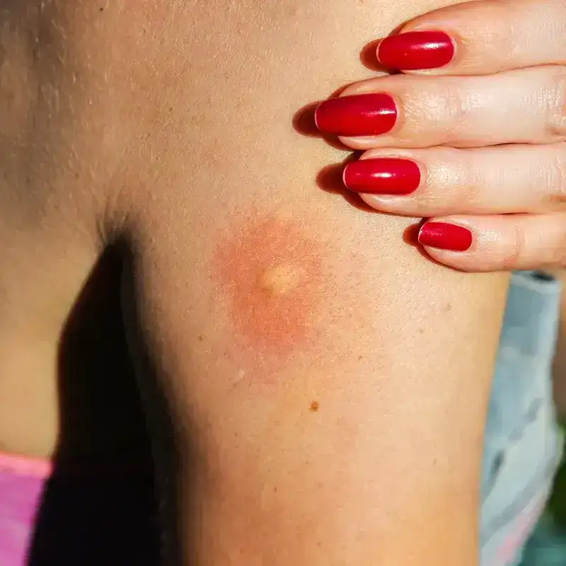 How to Get Rid of Bug Bites Fast