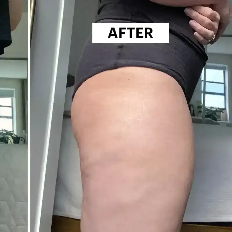 Writer Beth Shapouri's thighs before and after the Aveli cellulite treatment