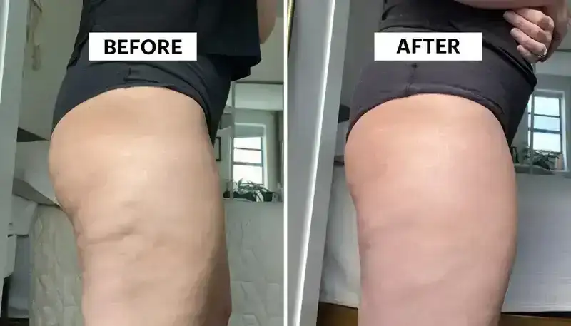 I Tried the Avéli Cellulite Treatment on My Butt and Thighs