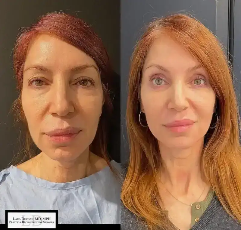 before and after photos of patient who received a blepharoplasty