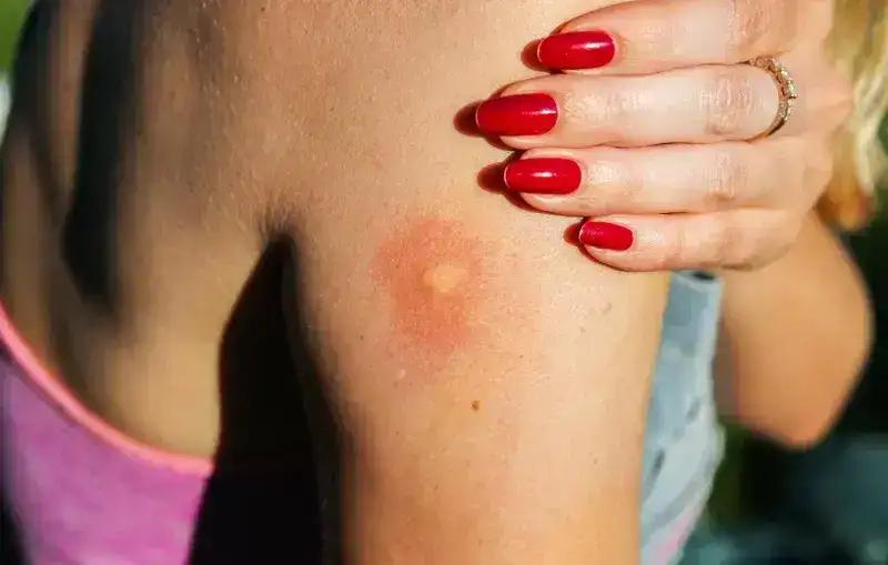 How to Get Rid of Bug Bites Before You Scratch Them Open