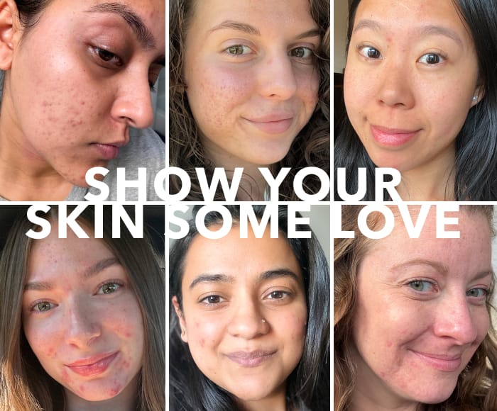 Show Your Skin Some Love | Breakouts are nothing to be ashamed of. Shop Skincare