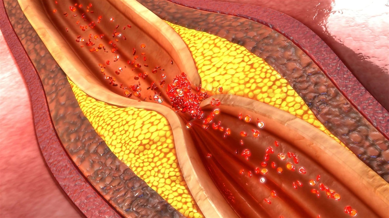 How to Clean Your Arteries - Naturally Prevent Blockage