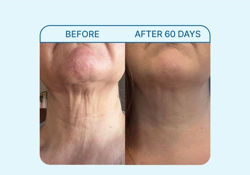 Neck Cream results after 60 days