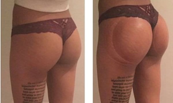Up to 60% Off on Non-Surgical Butt Lift at MSM Chicago Body Sculpting