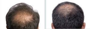Up to 70% Off on Laser Hair Restoration at Chicago Med Spa