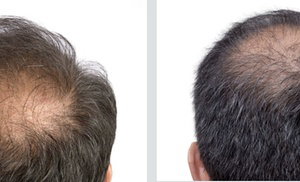 Laser Hair Restoration