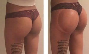 Non-Surgical Butt Lift