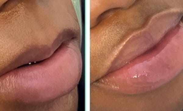 Lip Fillers