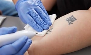 Tattoo-Removal Sessions