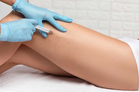 Up to 50% Off Non-Invasive Spider Vein Treatment at Radiant