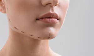 Up to 80% Off Double-Chin Treatment at Skinovatio Medical Spa - Gold Coast