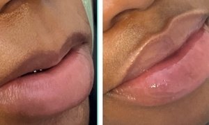 Up to 20% Off on Lip Fillers at BlancoWayMinks