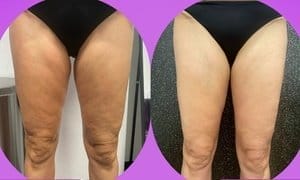 Sculpting and Radio Frequency Skin Tightening at Slim And Tone