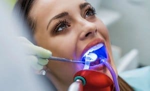 Glo Teeth-Whitening Session