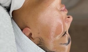 Up to 46% Off on HydraFacial at SKN2SKN Aesthetics