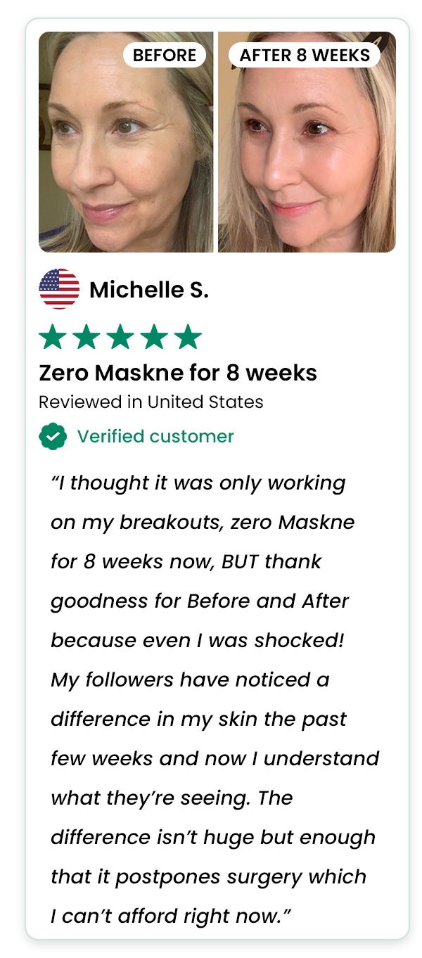 Zero Maskne for 8 weeks - Michelle