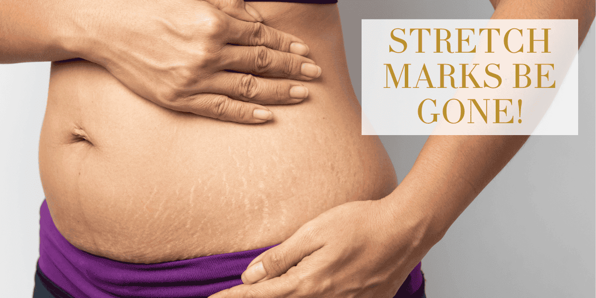 Stretch Marks