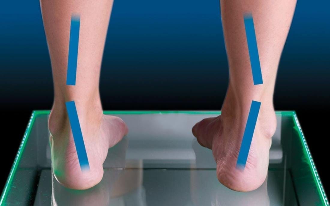 Supination Explained and Solved. Shop Insoles for High Arches and Supination.