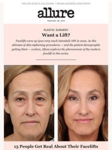 Everything You Ever Wanted to Know About Facelifts